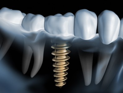 Implant package - Dental clinic Smile